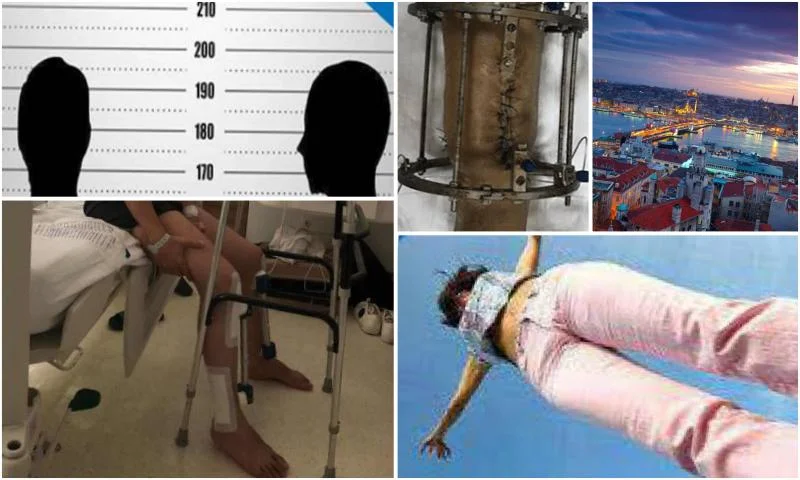 Türkiye'de Uzuv Uzatma -Limb Lengthening in Turkey