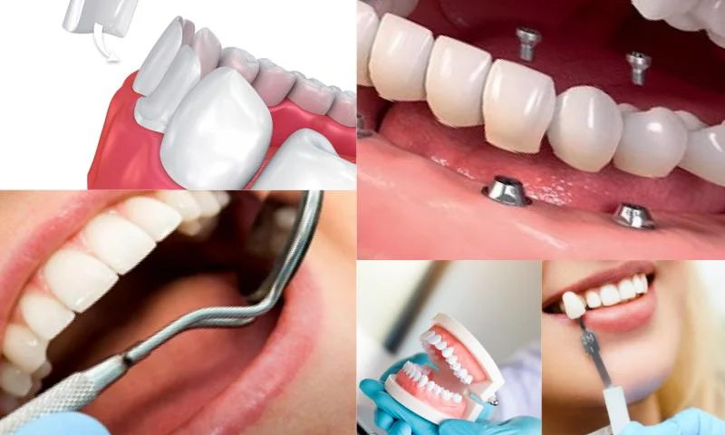 Bozulan Diş Sağlığı ve Estetiğinde Uygulanan Tedavi Yöntemleri