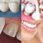 En İyi Diş Kaplama Hangisidir?