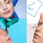 Türkiye'de Rinoplasti - تجميل الانف في تركيا Nerede Var?