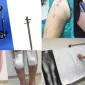 LEG LENGTHENING SURGERY FOR DWARFS